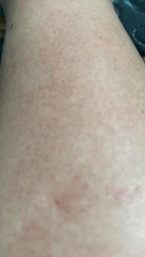 Kenapa ada ruam merah?