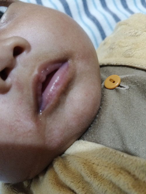 Ruam disekitar mulut