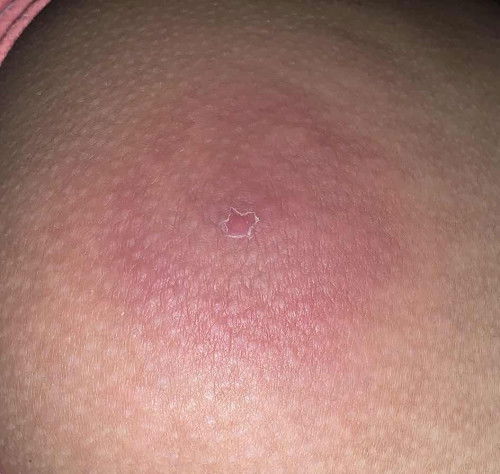 Pigsa sa pwet @21weeks preggy :(