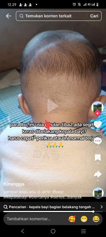 Di belakang kepala bayi 5bulan bentuk v tebalik keras