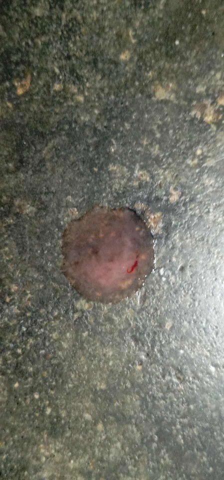 Implantation bleeding