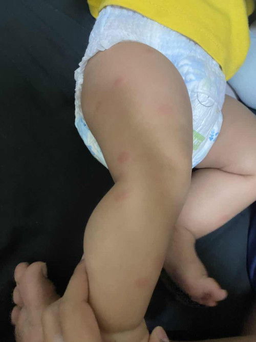 เม็ดแดงๆขึ้นที่ขา