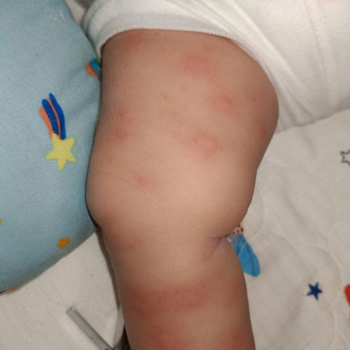 Allergy or insect bites?