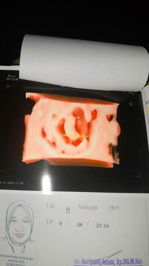 Hamil di luar kandungan