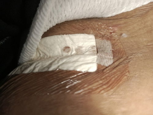 แผลผ่าคลอดมีเลือดออก