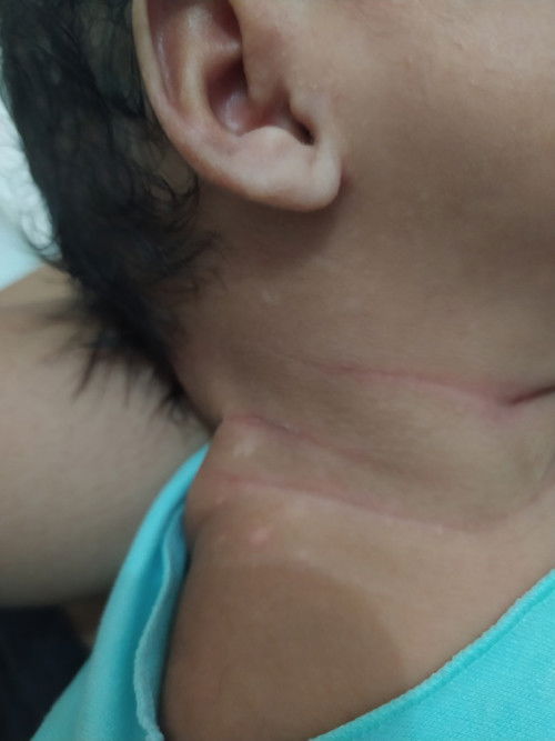 Muncul bercak putih seperti panu