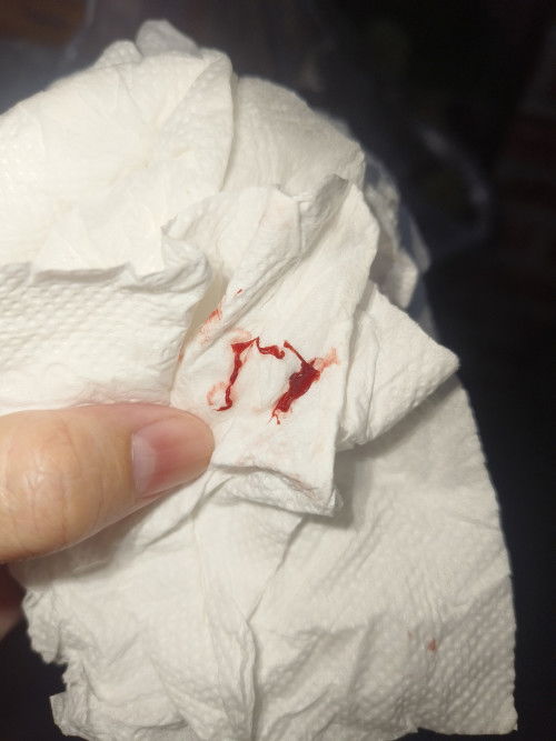 เลือดออกขณะตั้งครรภ์