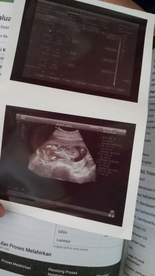 wort it g bun sy usg di puskesmas pke bpjs udh dpt cek darah + mms + calsium + buku kia + imunisasi