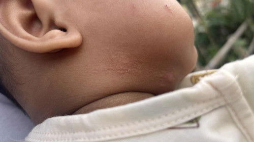 Alergi bukan ya mom? Seputar MPASI