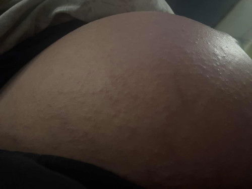 ตุ่มขึ้นที่ท้องค่ะ คันมากๆ