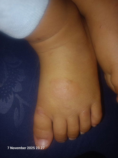 bun maaf ada yg punya pengalaman bayi kena scabies?apakah bentuk ruam nya kaya gini?.