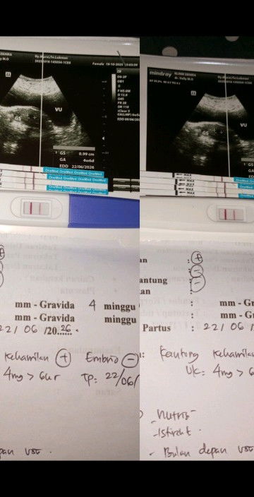 Pas pertama USG 6 mnggu udah kliatan kantng janin nya trus Kluar drah tpi garis 2 pas di USG GK ada