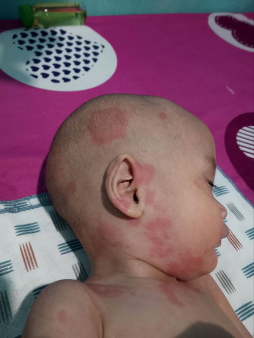 Ruam hilang datang lagi