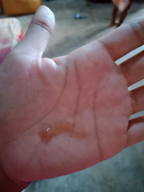 ท้อง37สัปดาห์มีมูกออกแบบนี้จะคลอดยังค่ะ