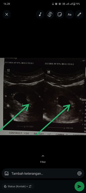 ini yg aku tunjuk janin bukan ya? soalnya kmrn usg dipuskesmas ga dijelasin secara detail jd gatau😅