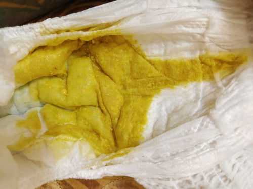 น้อง4เดือน อึแบบนี้ปกติมั้ยคะ