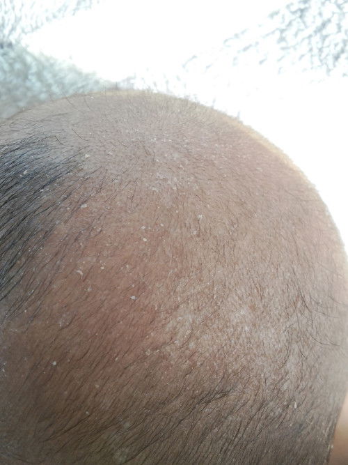 เกล็ดบริเวณหัว