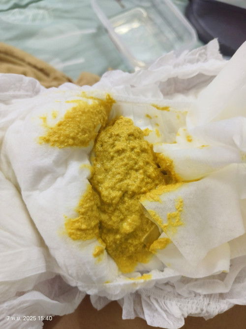 กินนมผง100% ถ่ายนี้ปกติไหมค่ะ