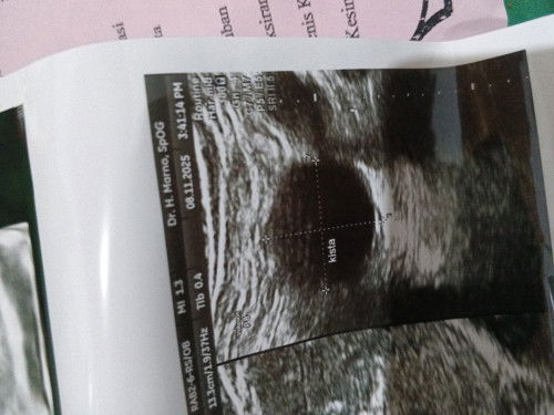 Bun, aku hamil anak k2, masuk 2 bln, di USG ada kistanya. Ad yg punya pengalaman sama ngak