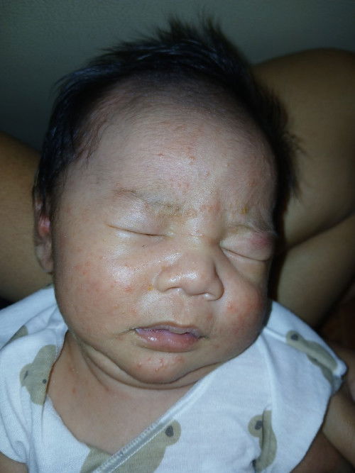 น้องเป็นผื่น