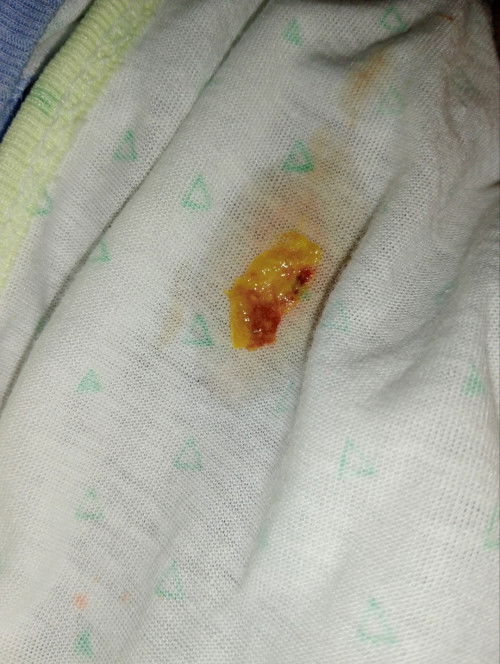 Ada yg sama GK Bun,bayi masuk 2 bln,pop nya berdarah,tp cuma sedikit, cuma yg d gambar aja,hrs gmna?