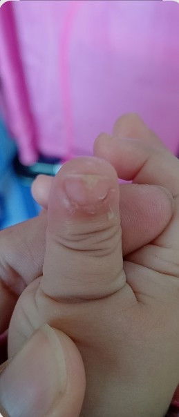 เล็บเป็นรอย