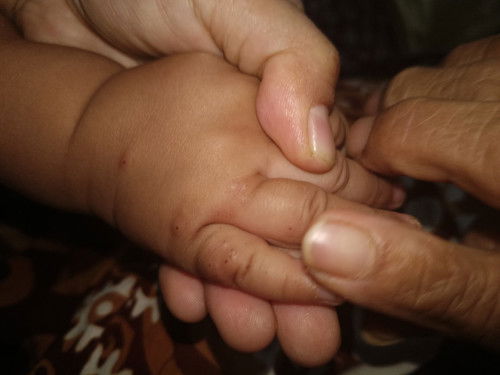 Bintik merah pada tangan anak
