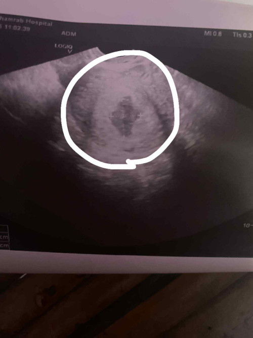 ท้อง 2 เดือน