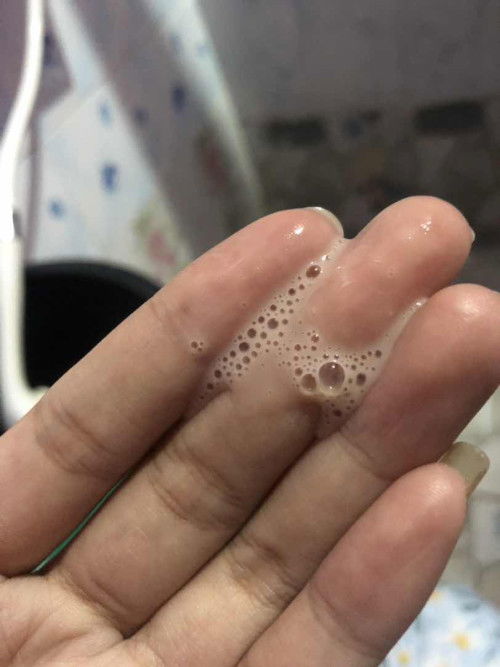 ท้อง32+4มีของเหลวออกจากช่องคลอด