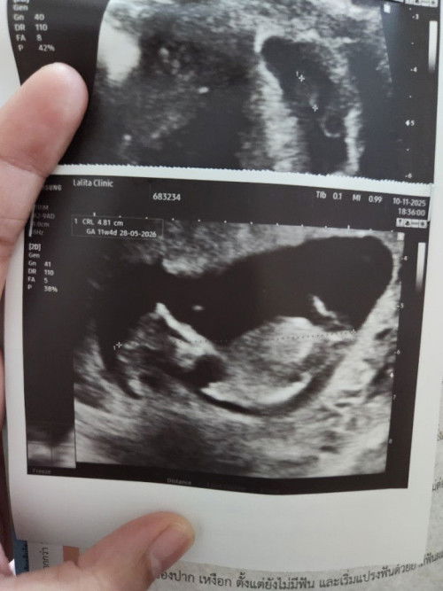 ท้องได้ 11w