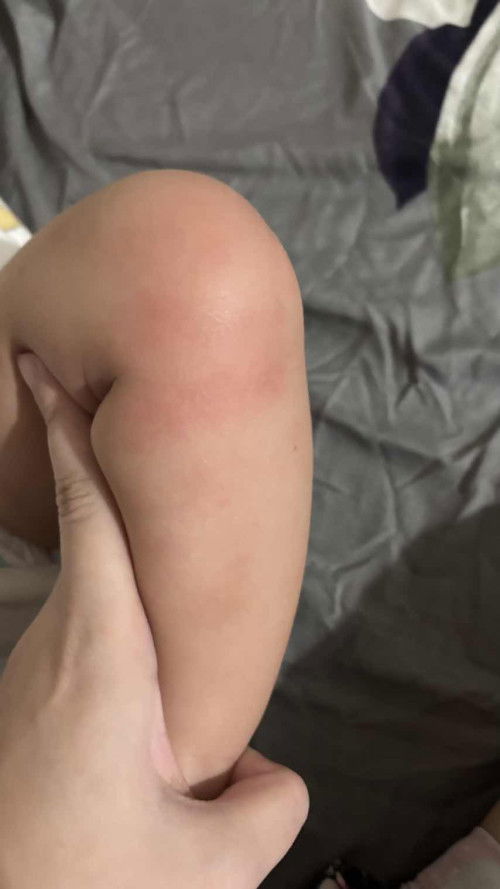 Merah pada kaki bayi 7 bulan