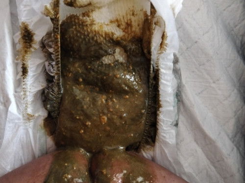 ถ่ายเปนสีเขียวคล้ำ ทานนมผงและนมแม่มาตั้งแต่แรกเกิดตอนนี้น้องอายุ1เดือน21วัน พึ่งมาถ่ายเป็นสีแบบนี้