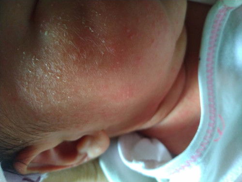 Bayi NB 2 minggu bentol merah seperti ruam