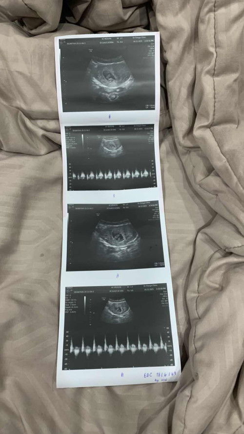 ซาวตอน 7 week เป็นแฝด