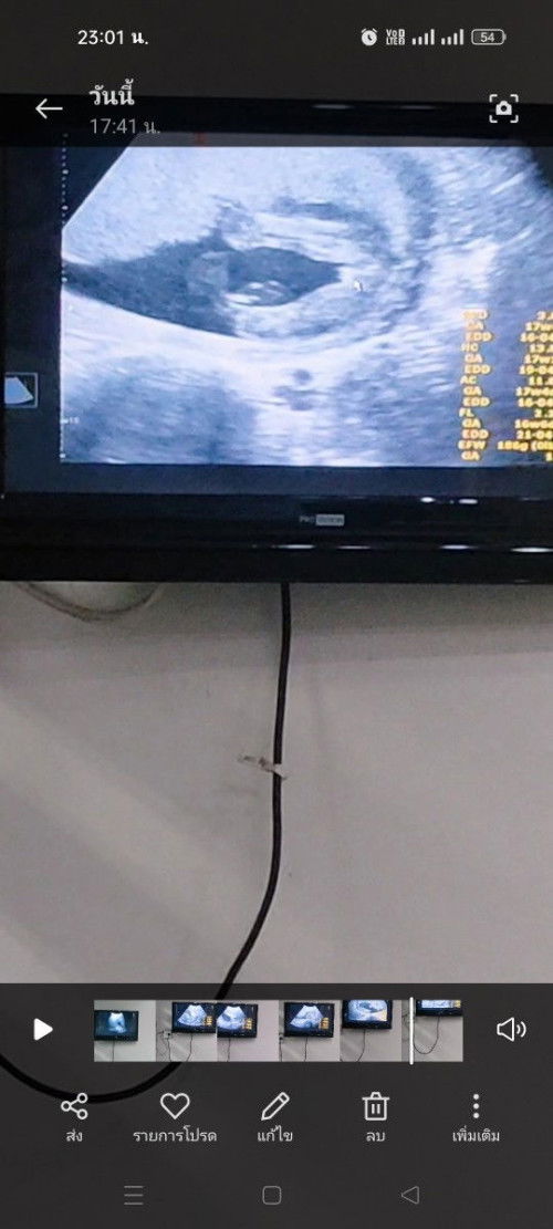 17 วีค หมอไม่แน่ใจชายหรือหญิงงงลุ้นนนมากค่ะ