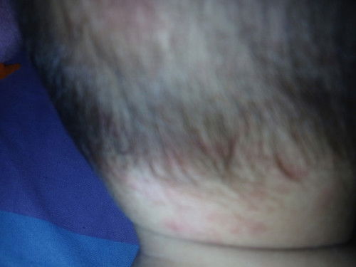 Tanda merah dari lahir