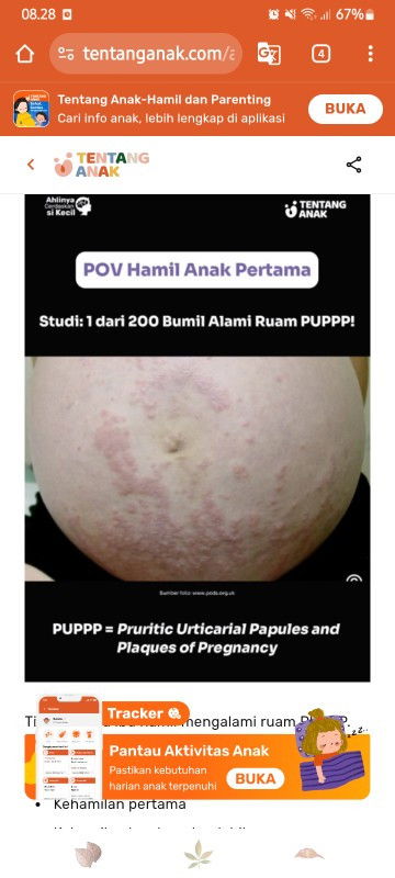 PUPPP GATAL KEHAMILAN MASUK TRIMESTER 3
