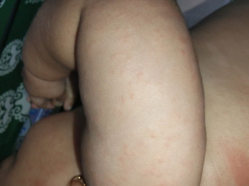 Bayi 4 bulan tumbuh bintik-bintik merah di kulit