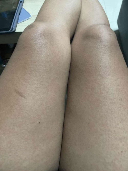 ท้อง39วีค ตัวแดงแต่ไม่คันต้องไปพบหมอไหมคะ