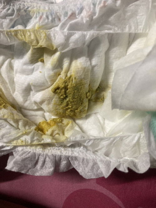 น้องถ่ายแบบนี้ปกติไหมคะ ถ่าย4รอบ  กะปิกะปอย น้อง4เดือน4วัน