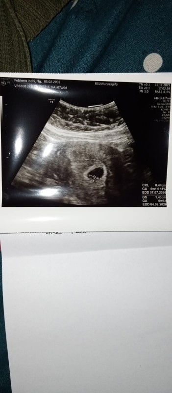 Hasil USG beda seminggu dri hpht