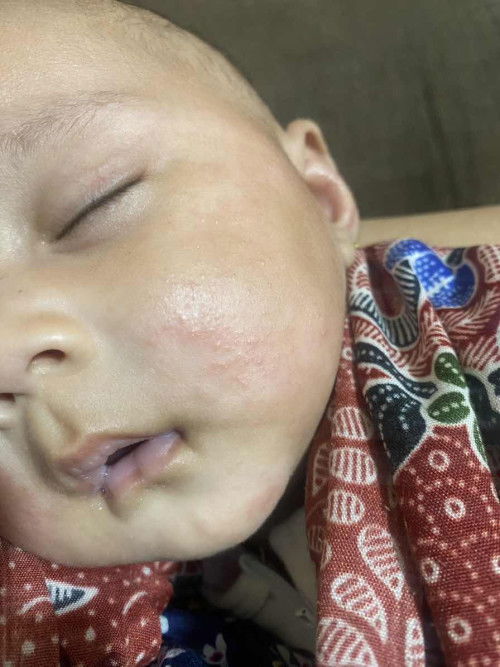 Ruam merah di wajah hilang timbul