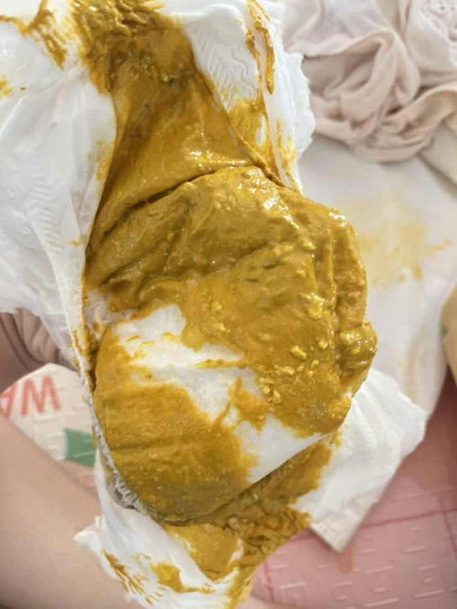 สีของอึเด็กทารก2เดือน19วัน