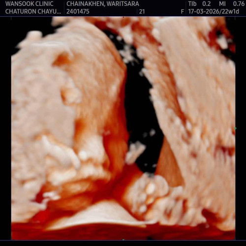 ผมเป็นเด็กผู้ชายครับแม่ๆ
22สัปดาห์1วัน
นํ้าหนัก 505g อ้าโชว์ไปเลย👶🏻💙