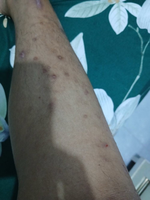 Obat gatal gatal