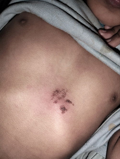 Halo kak ini tanda lahir anak sy dr lahir , tapi skrg sudah 5 tahun kok tiba² memerah dan gatal