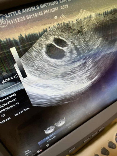 Twins 9weeks and 4days