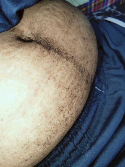 แนะนำครีมลดรอยแผลเป็น