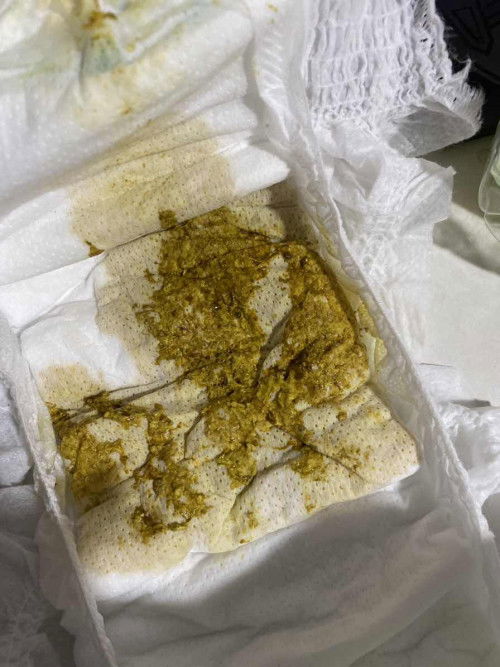 สีอึแบบนี้ปกติไหมคะ