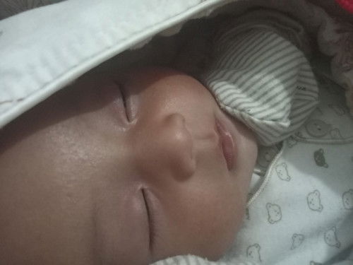 Bagaimana cara mengatasi ruam dipipi?